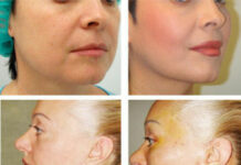 Нити Аптос для подтяжки лица: современный эффективный способ омоложения