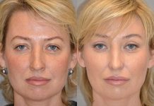 Биоармирование лица: коррекция выраженных возрастных изменений