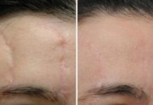 Лечение рубцов: новейшие методы