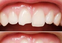 Что представляет собой художественная реставрация зубов?