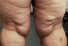 Почему жир откладывается на ногах?