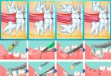 Как чистить зубы после удаления зуба мудрости: правила ухода