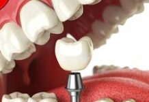 Имплантация зубов в современной стоматологии