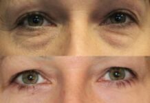 Преимущества блефаропластики