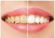 Отбеливание зубов: профессиональная стоматологическая процедура для осветления эмали зубов