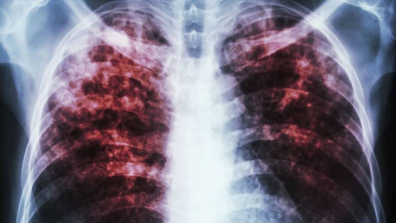 <br />
Мясников предупредил о возможной вспышке туберкулеза в России                