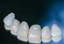 Установка циркониевых коронок