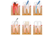 Как лечат пульпит: современные методы