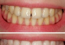 Особенности эстетической реставрации зубов