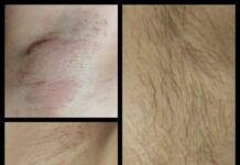 Электроэпиляция : возможность избавиться от волос навсегда