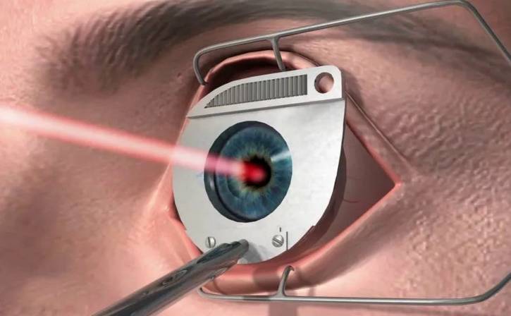 <br />
Делать ли лазерную коррекцию людям с плохим зрением: плюсы и минусы                