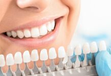 Что такое керамические виниры