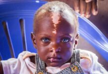 Мутанты среди нас: прекрасные аномалии внешности человека