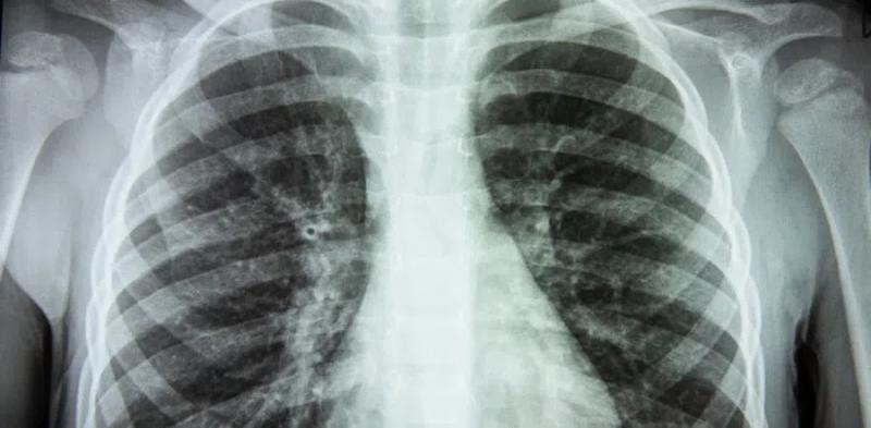 Диагностика коронавируса без ПЦР: как можно диагностировать заболевание с помощью рентгена