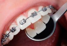 Зачем нужны брекеты: преимущества и недостатки установки систем