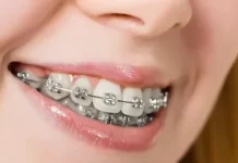Какие брекеты лучше ставить взрослому и подростку?