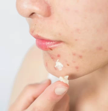 Причины возникновения акне