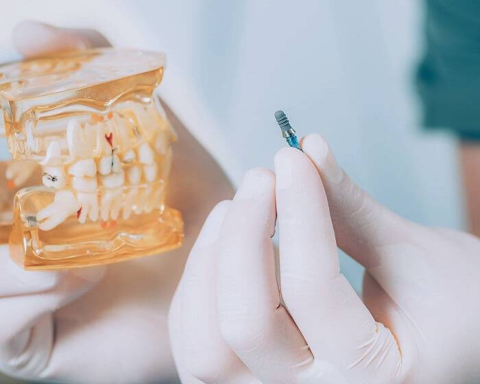 <br />
Новое открытие: почему к 2030 году людям не нужно будет ставить импланты зубов                