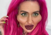 Украинская модель с «самыми большими щеками в мире» рассказала о проблемах со здоровьем